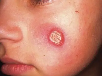 سالک؛ بیماری که نباید نادیده گرفته شود