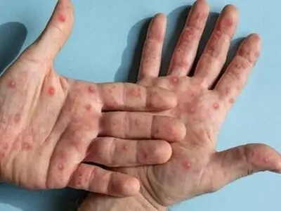 تایید دومین مورد آبله میمونی جهش‌یافته در خارج از آفریقا / زنگ خطر همه‌گیری؟