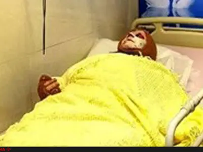 "اسید" تمام نسوج عمقی سر و صورت "معصومه" را سوزانده/ ۷ عمل جراحی دیگر نیاز است