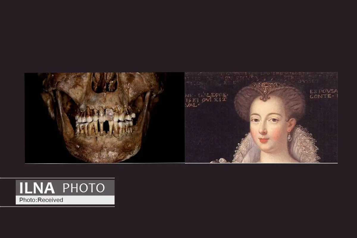 تن دادنِ زنِ قرن هفدهمی به عمل  دردناکِ دندانپزشکی برای حفظ دندان‌های خود