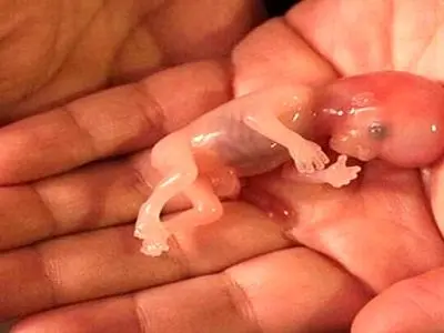 با این کارها از سقط خودبه خودی جنین جلوگیری کنید