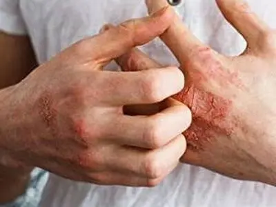 درمان خانگی و گیاهی اگزمای پا و بدن