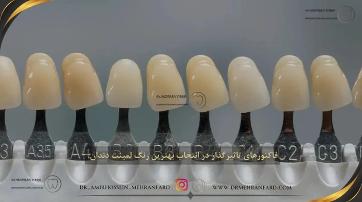 ۷ مورد از مواردی که قبل از انجام لمینت دندان باید بدانید! + [ فیلم مراحل ]
