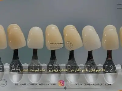 ۷ مورد از مواردی که قبل از انجام لمینت دندان باید بدانید! + [ فیلم مراحل ]