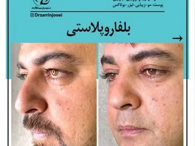 رفع پف چشم و افتادگی پلک با روش بلفاروپلاستی