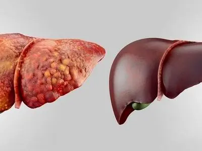 سرکه، آبغوره و ادویه برای کبد چرب خوب هستند یا بد؟