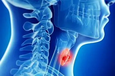 کم‌کاری تیروئید در نوزادان و زنان از مشکلات مهم حوزه سلامت 

