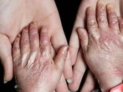 بیماری پروانه‌ای بیشتر در خانواده‌ های دارای ازدواج فامیلی بروز می‌کند