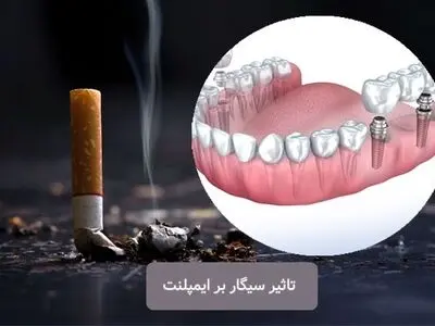 چند روز بعد از ایمپلنت می‌توانم سیگار بکشم؟