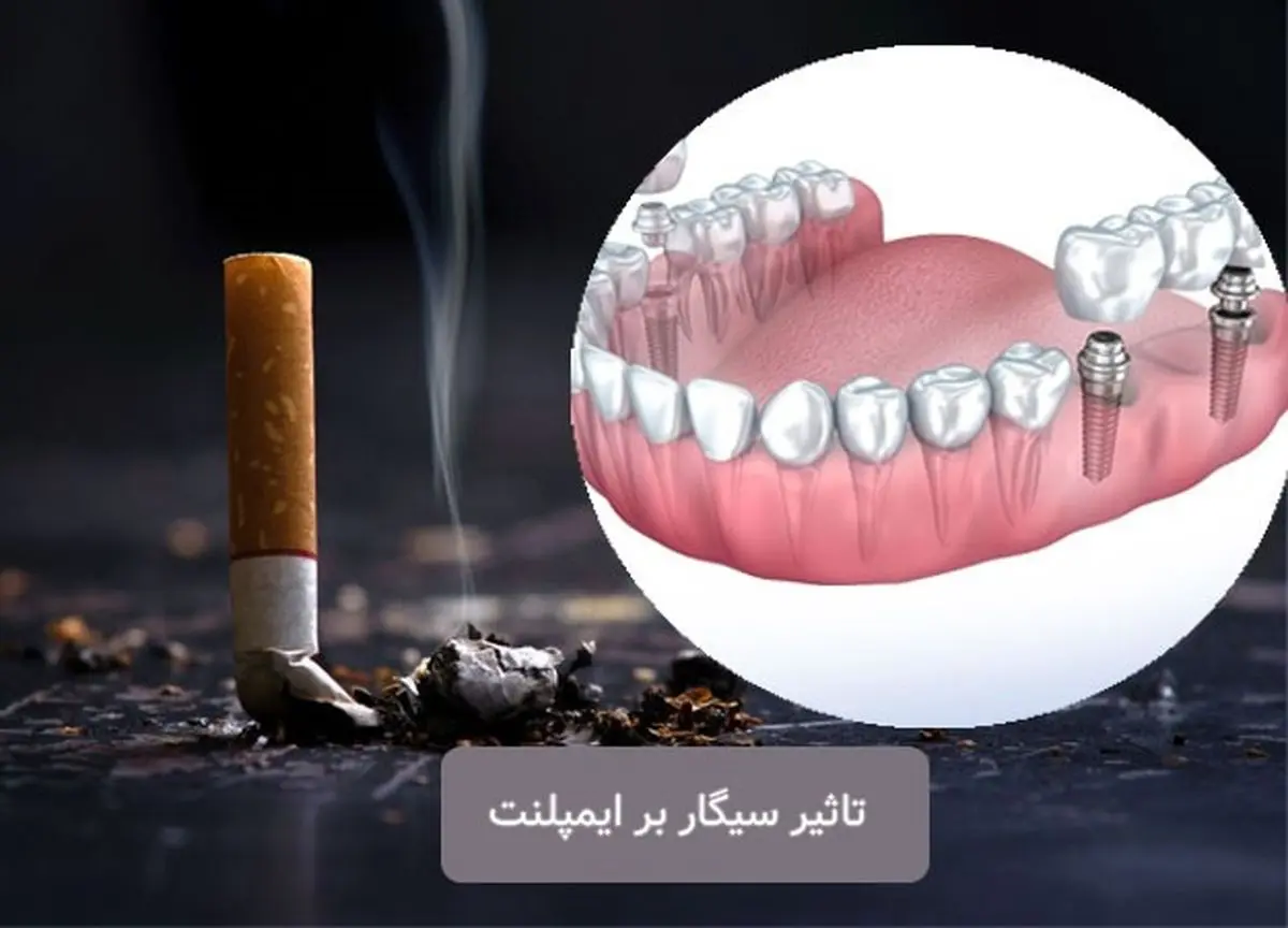 چند روز بعد از ایمپلنت میتوانم سیگار بکشم؟