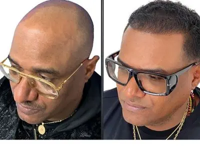 زراعة الشعر في إیران بسعر وجبة الغداء 