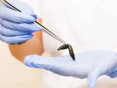 خواص درمانی زالو در طب سنتی