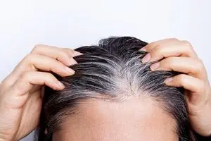 آیا ریزش مو با کمبود مصرف پروتئین ارتباط دارد؟