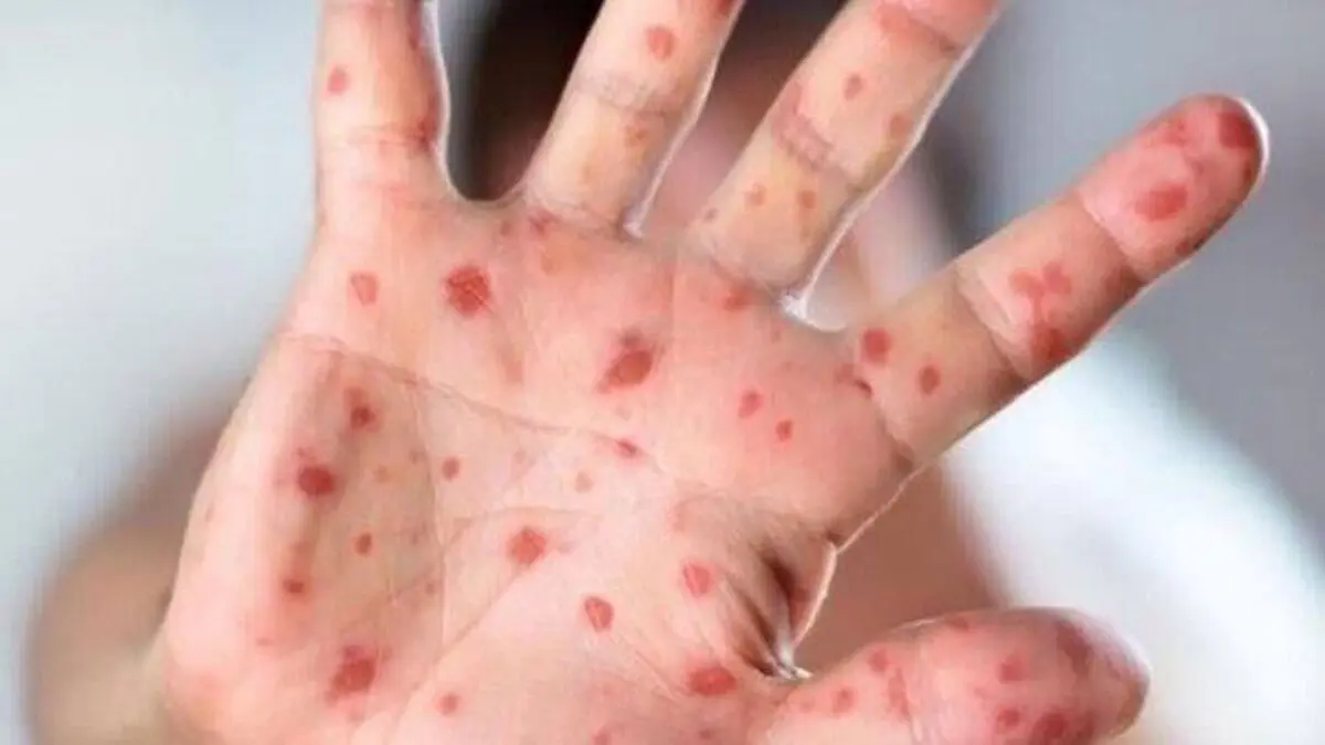 شناسایی ۲ مورد بیمار مشکوک به سرخک در آذربایجان غربی 