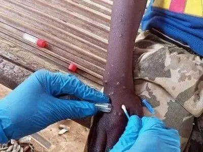 نشانه‌های ابتلا به بیماری آبله میمونی