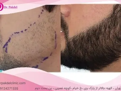 کاشت ریش چگونه انجام می‌شود؟ فیلم, قیمت, عوارض