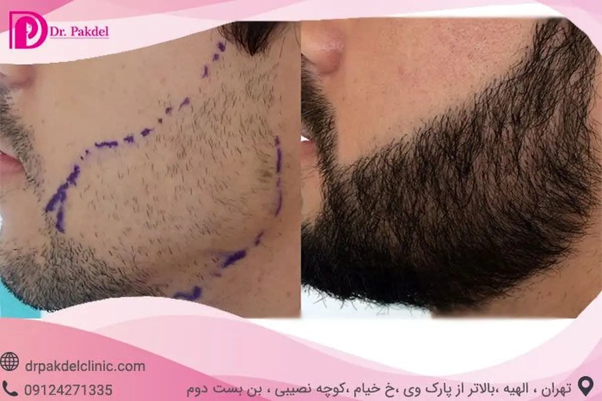 کاشت ریش چگونه انجام می‌شود؟ فیلم, قیمت, عوارض