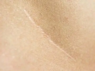 راهکارهای گیاهی برای رفع گوشت اضافه جای زخم