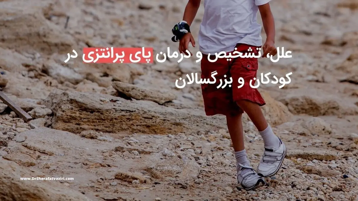 علل، تشخیص و درمان پای پرانتزی در کودکان و بزرگسالان