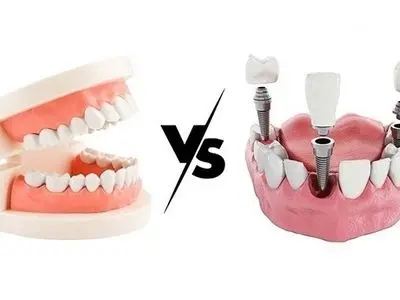 ایمپلنت بهتر است یا دندان مصنوعی؟ نکاتی که باید بدانید