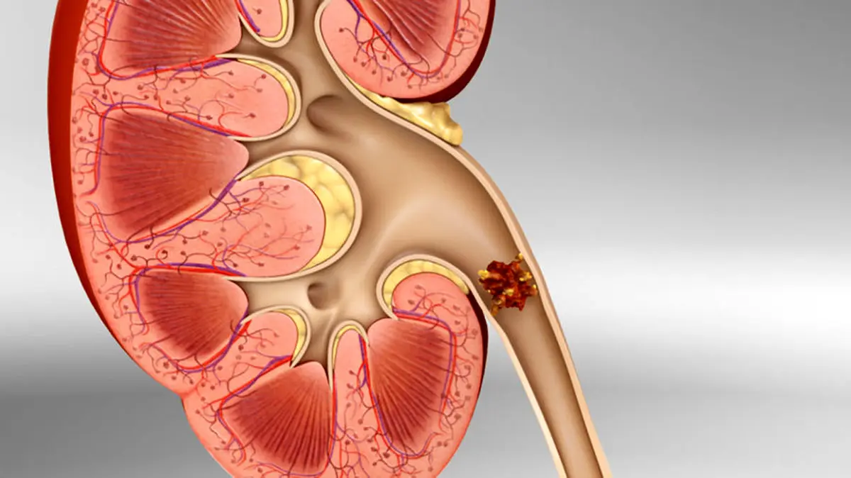درمان فوری سنگ کلیه با هندوانه پخته