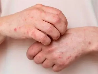 تاکید بر دریافت واکسن آبله برای بزرگسالانی که قبلا نزدند