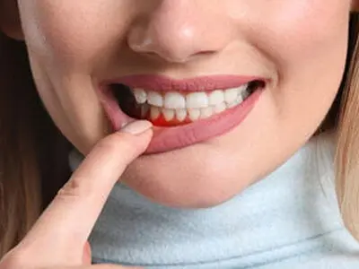 علت سیاه‌شدن لثه‌ها چیست؟