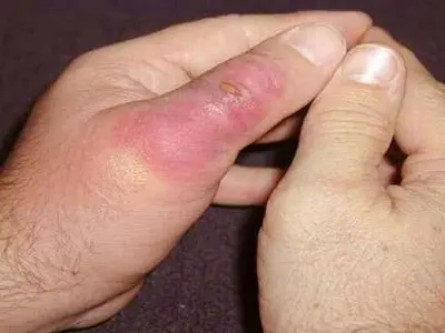 هشدار جدی دانشگاه علوم پزشکی هرمزگان درباره افزایش موارد گزش در فصل گرما