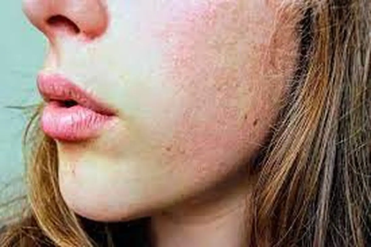 علائم و نشانه های تیروئید بر روی پوست و مو
