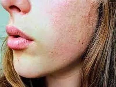 علائم و نشانه های تیروئید بر روی پوست و مو