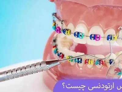 نحوه عملکرد بریس ارتودنسی + فیلم