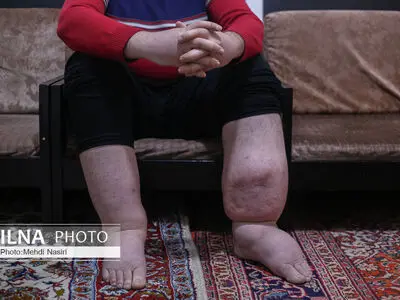 روایتی از سختی زندگی با "لنف ادم اولیه"/ هزینه‌ها بالاست؛ بی‌خیال درمان شدم+ عکس و فیلم