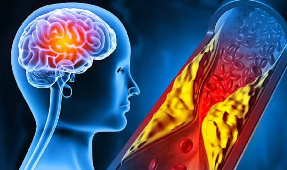 این لبخند بوی سکته می‌دهد
