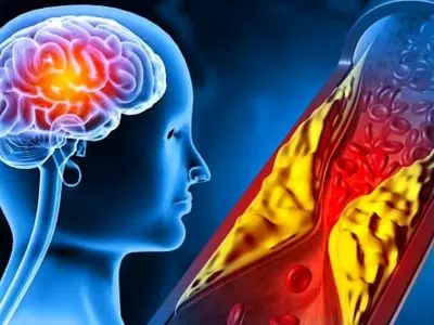 این لبخند بوی سکته می‌دهد