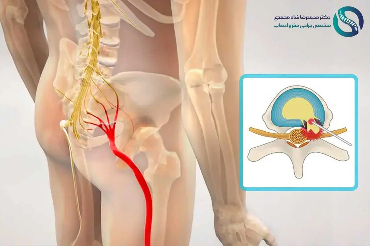 سیاتیک چیست؟ و لیزر دیسک کمر چگونه باعث درمان درد سیاتیک می‌شود؟ پاسخ متخصص