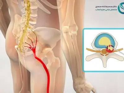 سیاتیک چیست؟ و لیزر دیسک کمر چگونه باعث درمان درد سیاتیک می‌شود؟ پاسخ متخصص