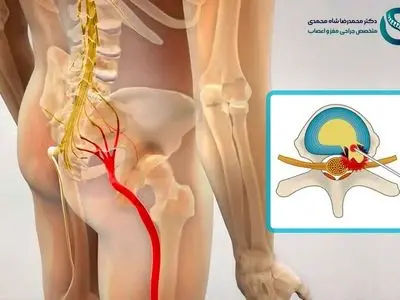 سیاتیک چیست؟ و لیزر دیسک کمر چگونه باعث درمان درد سیاتیک می‌شود؟ پاسخ متخصص