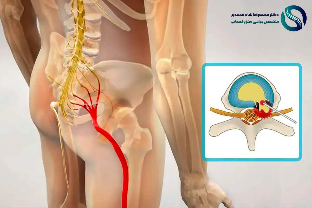 سیاتیک چیست؟ و لیزر دیسک کمر چگونه باعث درمان درد سیاتیک می‌شود؟ پاسخ متخصص