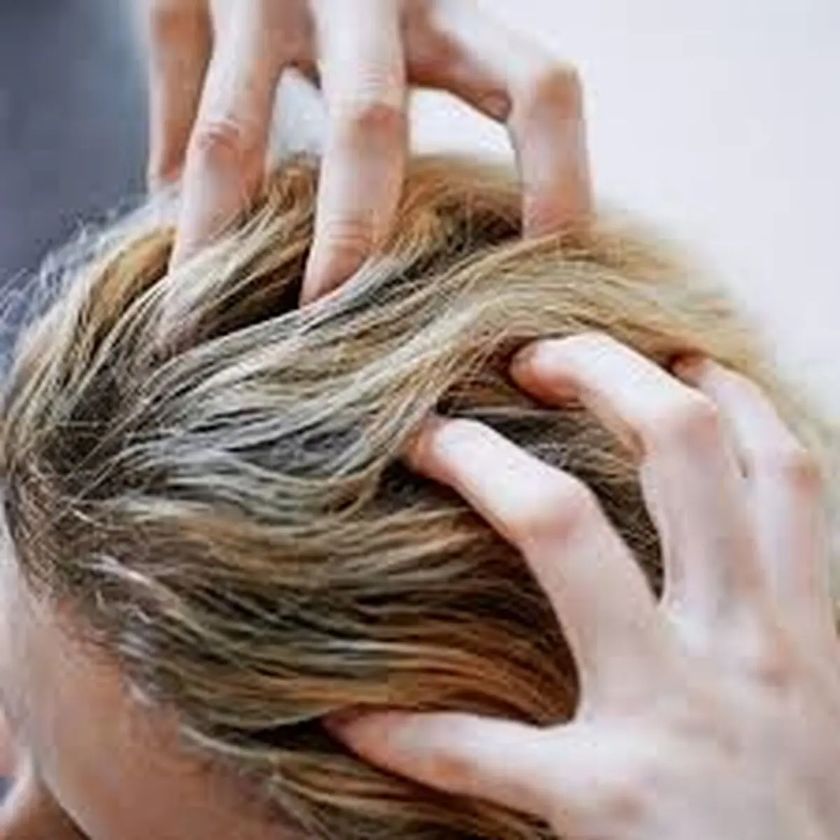 کاشت مو به روش SUT در کلینیک کاشت مو و زیبایی رویان سلامت