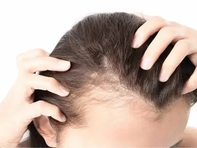 چهار توصیه مهم برای کسانی که ریزش مو دارند 
