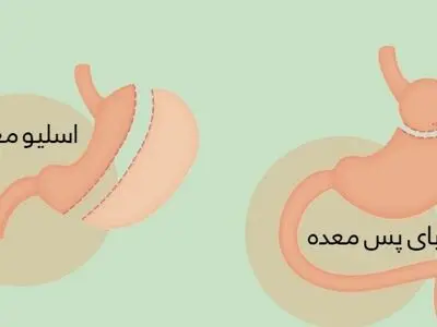 عمل اسلیو بهتر است یا بای پس؟ + مقایسه