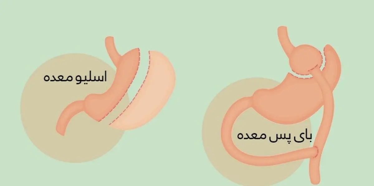 عمل اسلیو بهتر است یا بای پس؟ + مقایسه