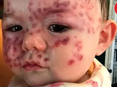 دردسر خال مادرزادی عجیب نوزاد برای مادرش+عکس