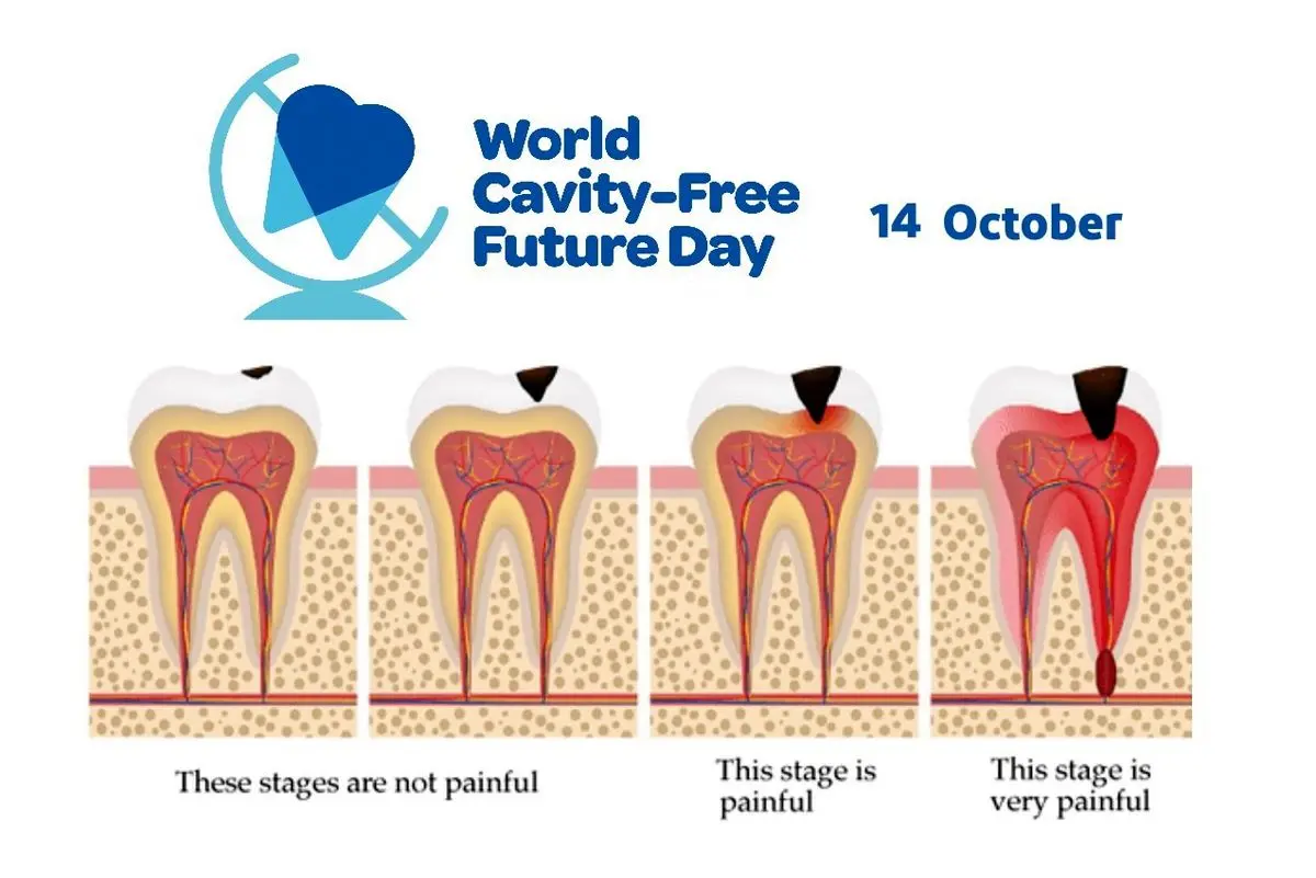 ۱۴ اکتبر روز جهانی بدون پوسیدگی دندان است