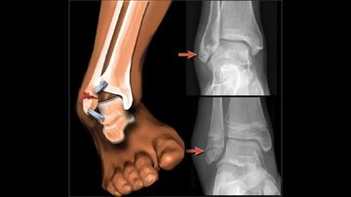 کمک‌های اولیه «شکستگی» در شرایط جنگی و بحران