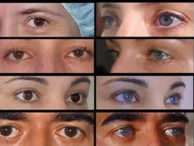 با 17,000,000 تومان، چشمان قهوه‌ای خود را آبی کنید