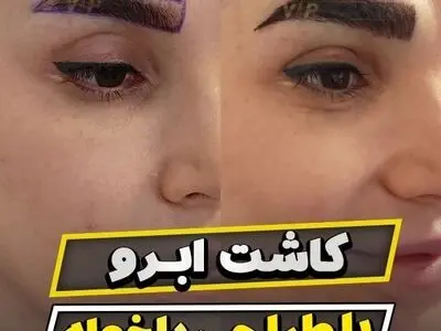 بهترین دکتر کاشت ابرو تهران چه کسی است؟