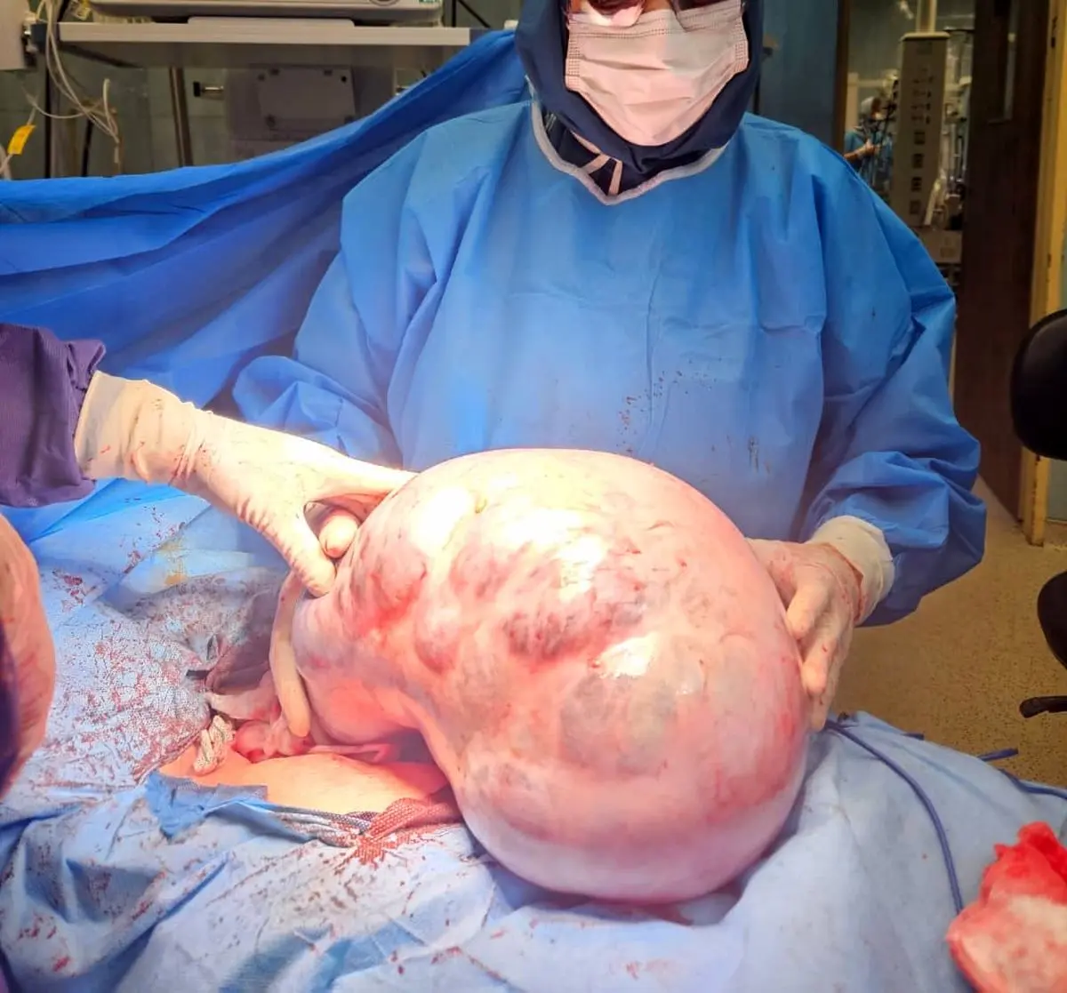 خارج‌ کردن  توده ۱۰ کیلویی از شکم بیمار در کرج