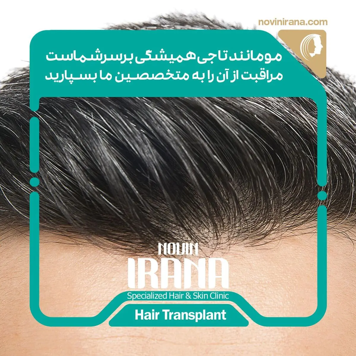 کاشت مو و جراحی لیپوساکشن با کلینیک نوین ایرانا