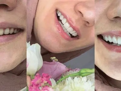 با لمینت دندان زیبایی را به لبخند خود هدیه دهید